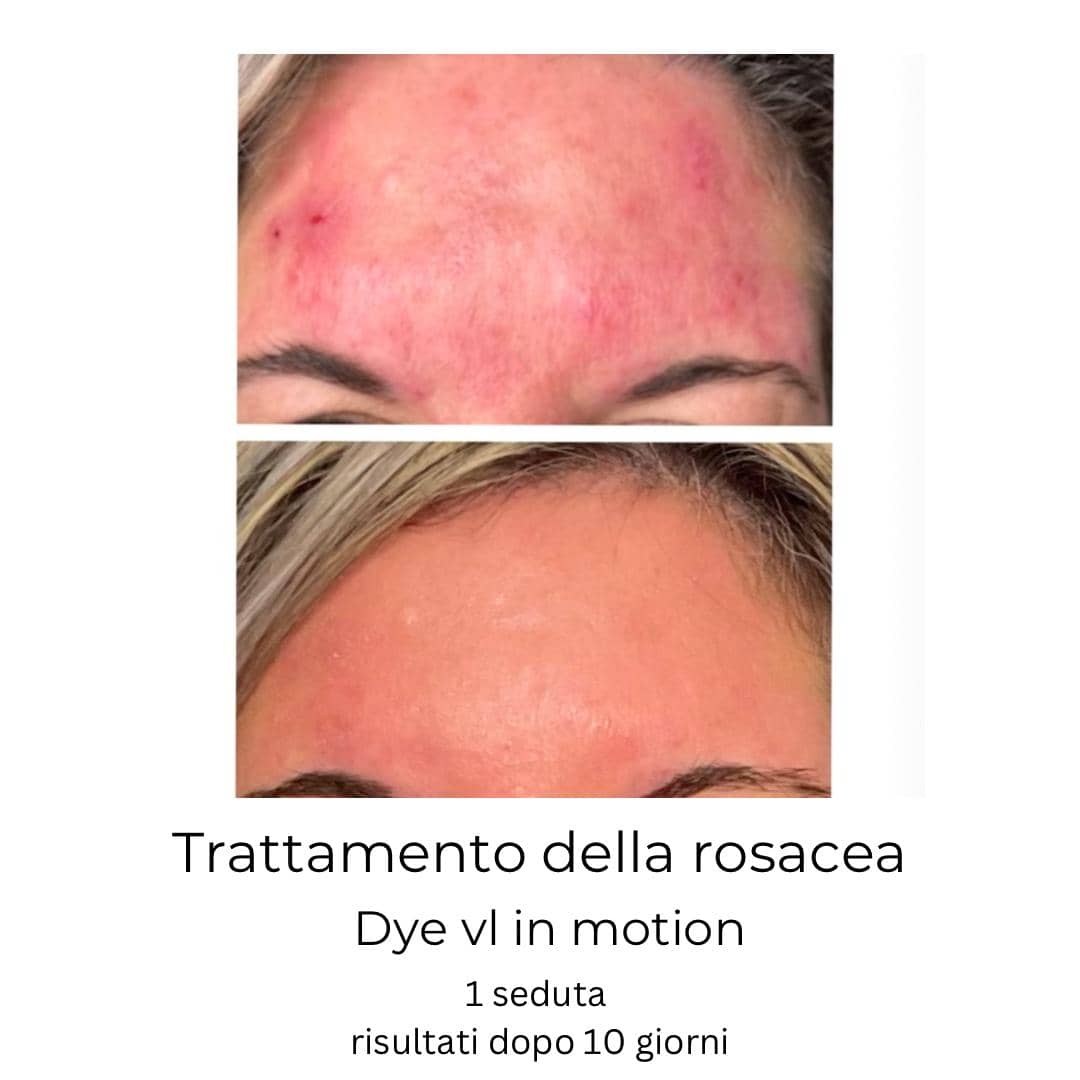 trattamento della rosacea