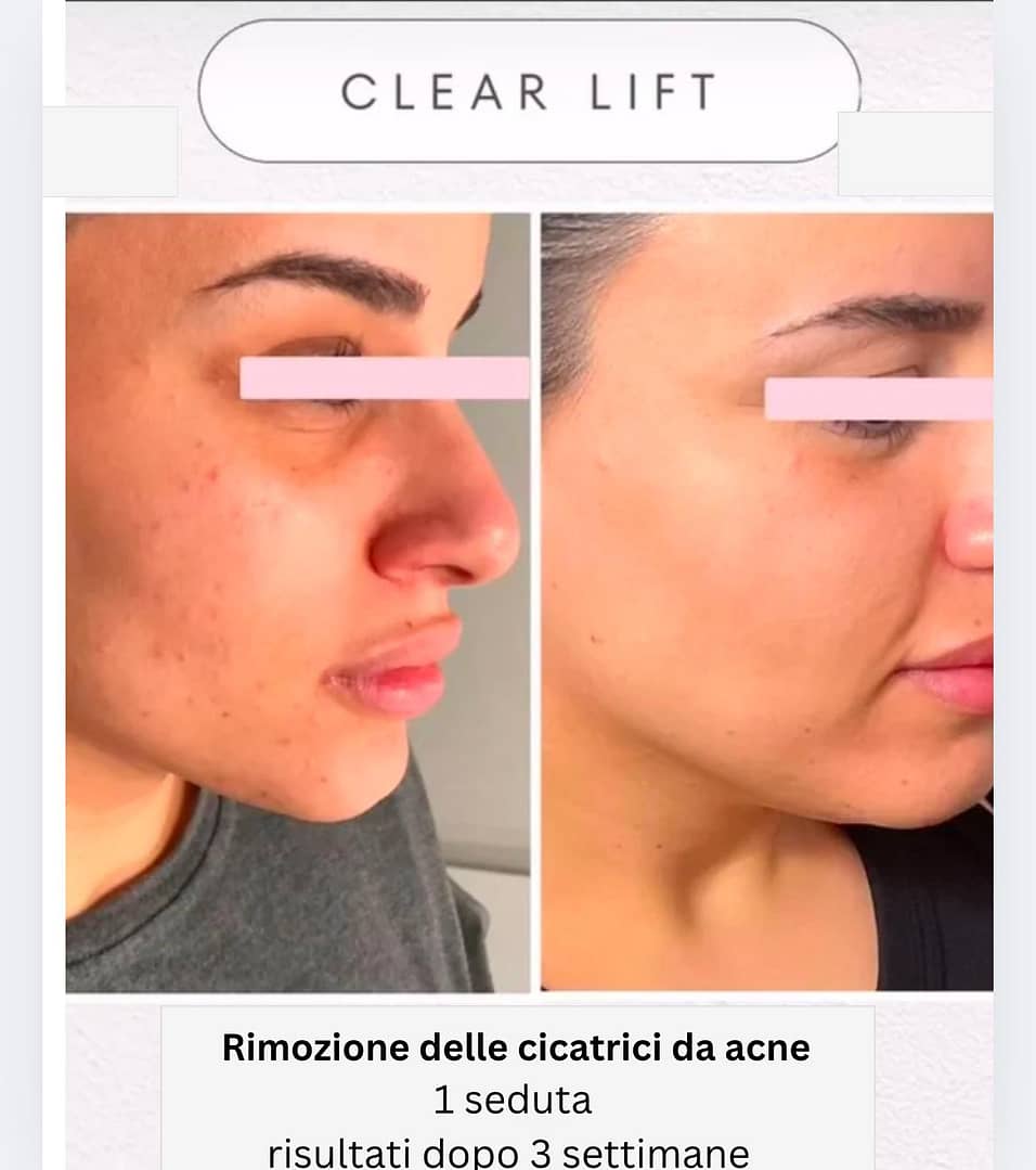 cicatrici da acne